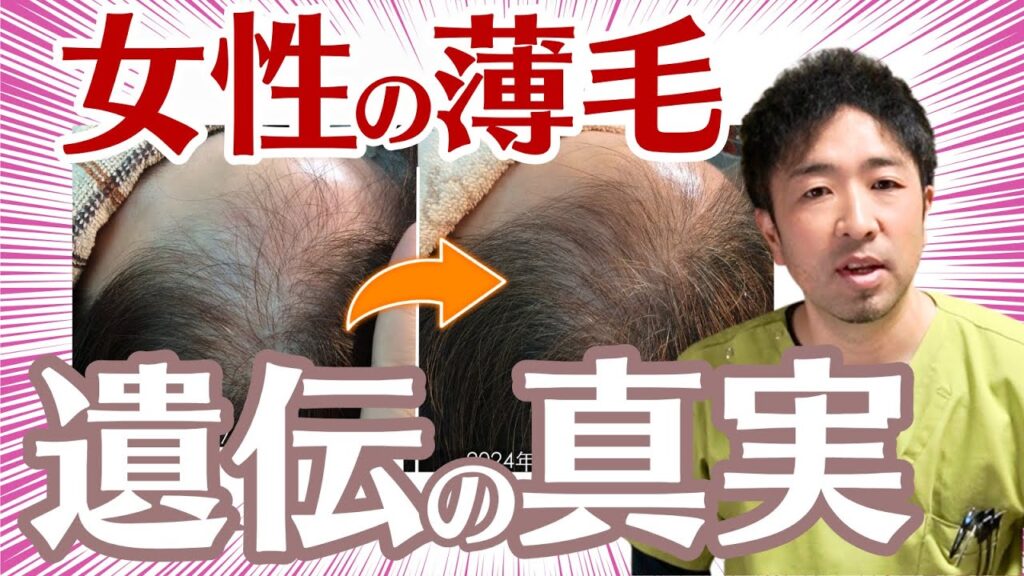 女性の薄毛は遺伝するのか?メカニズムと対策法を徹底解説【58歳女性発毛症例】