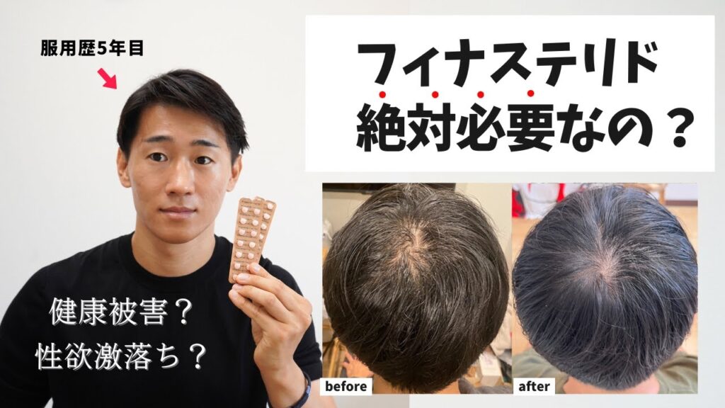 【薄毛改善】AGA治療にフィナステリドは絶対に必要なのか?副作用(性欲減退・肝機能障害)のリスクと代替案について本気で考えてた。