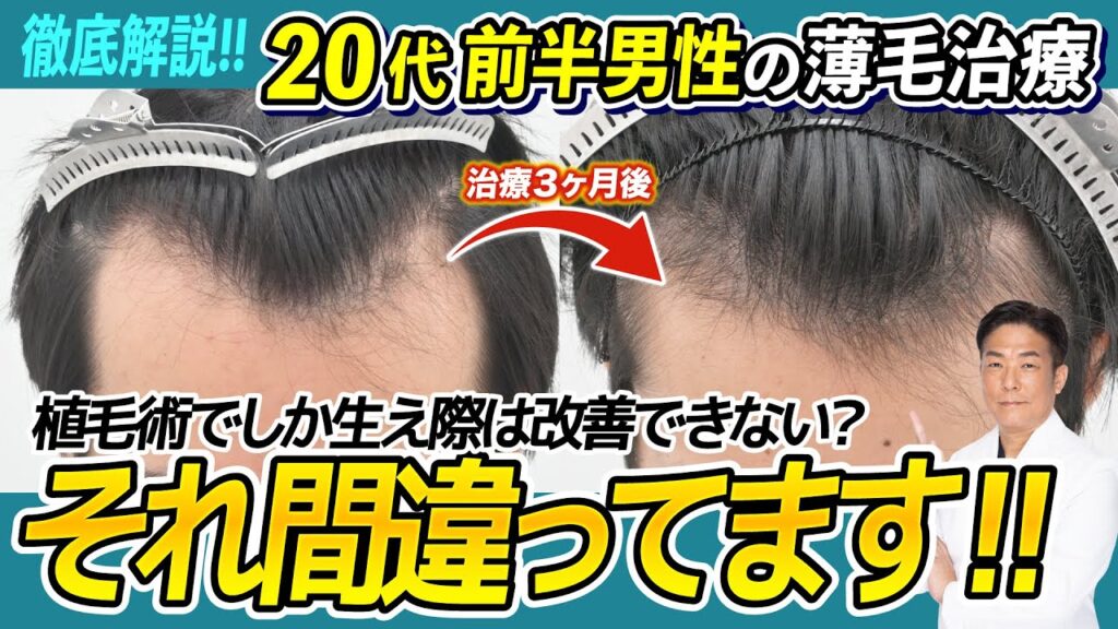 【徹底解説】生え際の後退は植毛でしか改善できないと思ってない？それ間違いです！！-20代男性の治療解説-