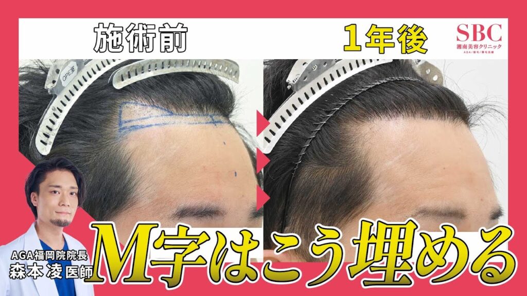 【脱M字ハゲ】自毛植毛で生え際が高密度になるまでの経過を解説!