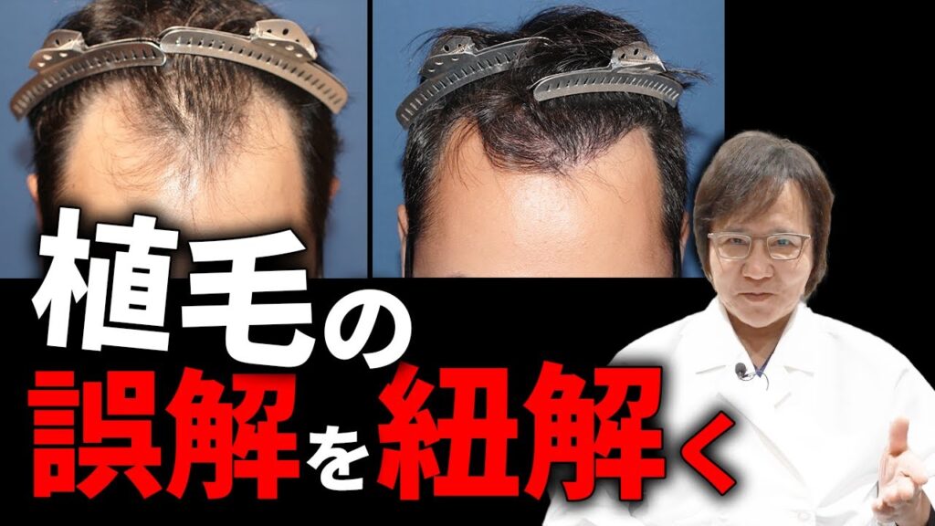 【自毛植毛】植毛を受ける前に知っておくべきこと3選