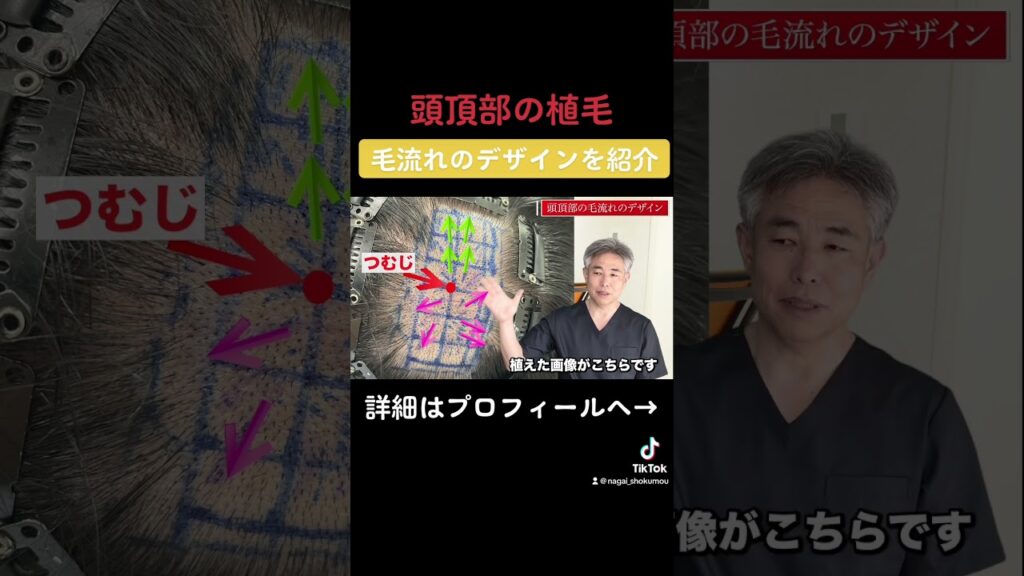 【頭頂部植毛の実例】頭頂部の毛流れのデザインをご紹介します#shorts