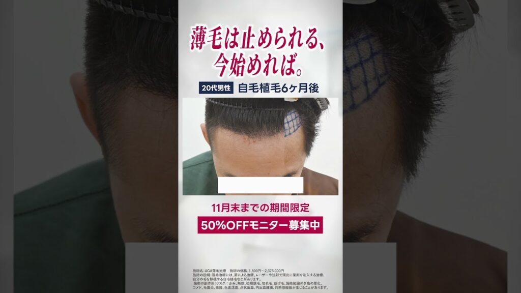薄毛治療の経過 #自毛植毛