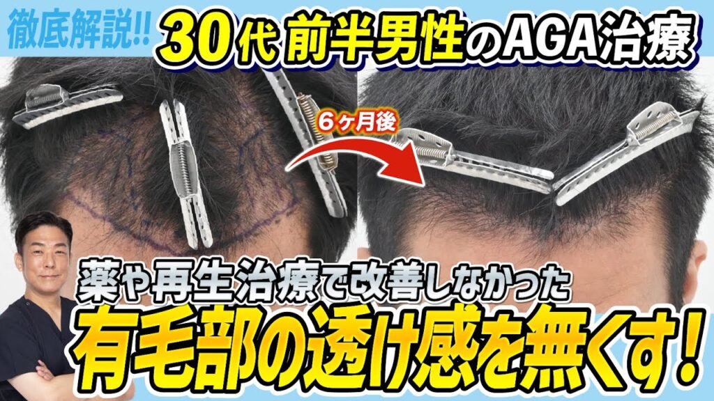 【必見】自毛植毛でM字の透け感を治す！薬や治療で改善しなかった方へ-30代男性の治療解説-