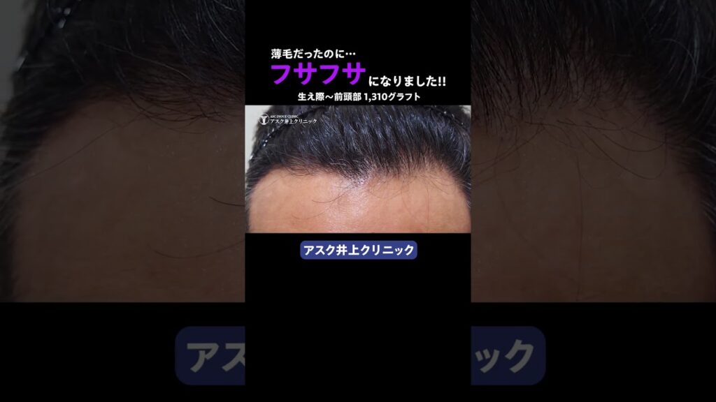男性  生え際から前頭部  1,310グラフト　薄毛治療　自毛植毛アスク井上クリニック症例 #shorts