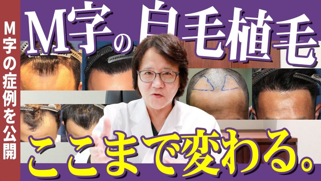 【自毛植毛】M字に特化した自毛植毛の症例！！【薄毛】【AGA治療】