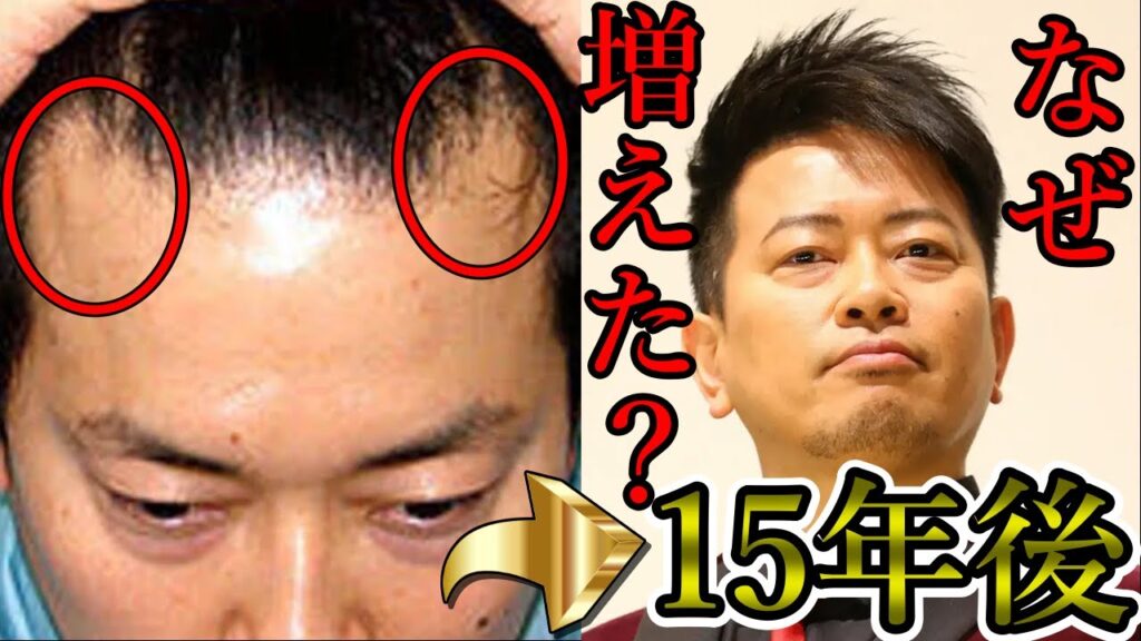 宮迫博之は「元ハゲ」!?薄毛克服の秘密を徹底解明！