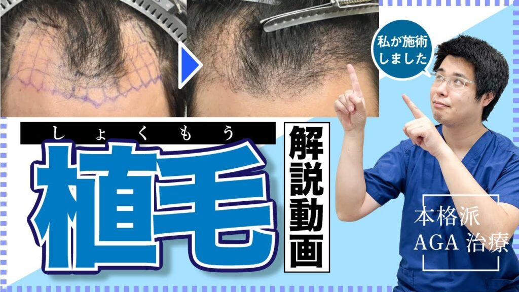 【薄毛治療】現役医師が完全解説!自毛植毛について【湘南AGAクリニック名古屋院】
