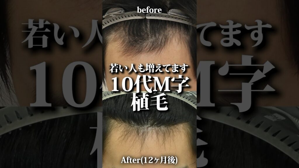 10代でもM字に植毛で悩み解消 #aga治療 #薄毛 #薄毛治療