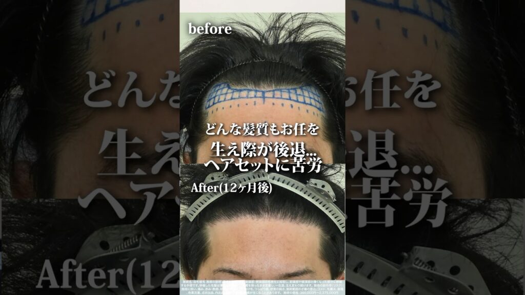 どんな髪質もお任せください！高密度自毛植毛で生え際後退を解決 #aga治療 #薄毛治療 #メンズヘアセット