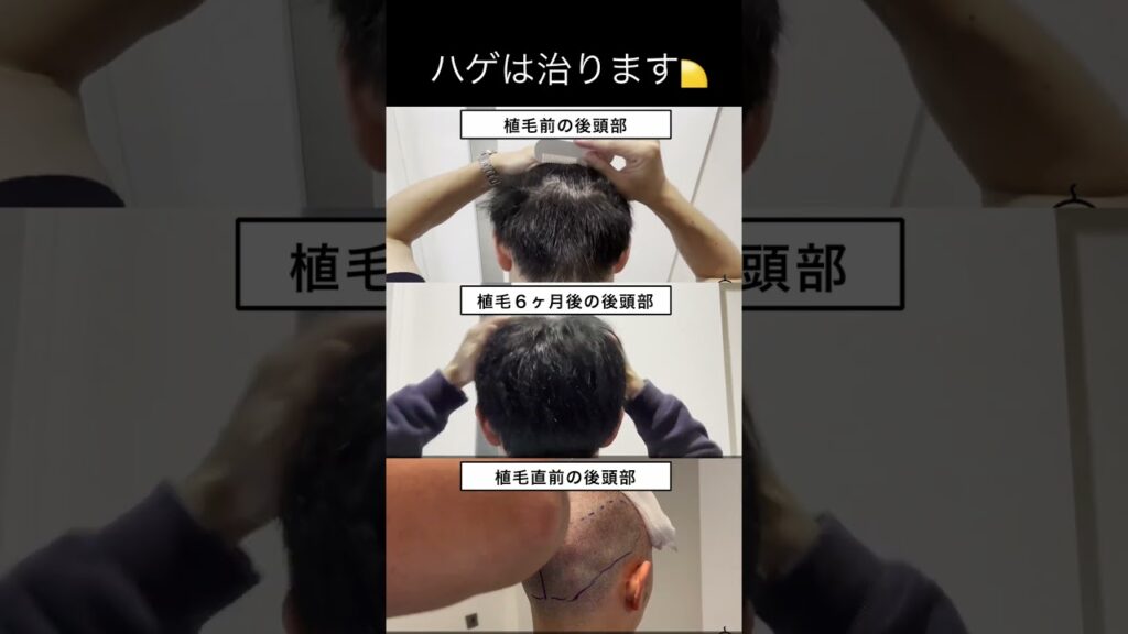 【後悔?】5200株植毛したら後頭部が... #aga #hairstyle #トルコ植毛 #薄毛 #hair #植毛 #自毛植毛 #shorts