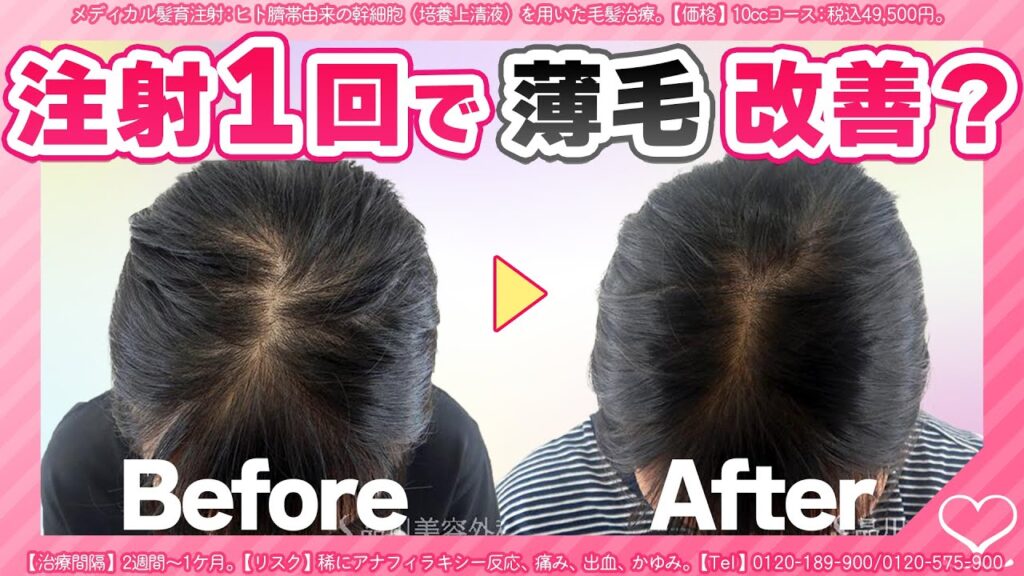 飲み薬なし! 薄毛治療 の経過を写真で紹介【 メディカル髪育注射 】