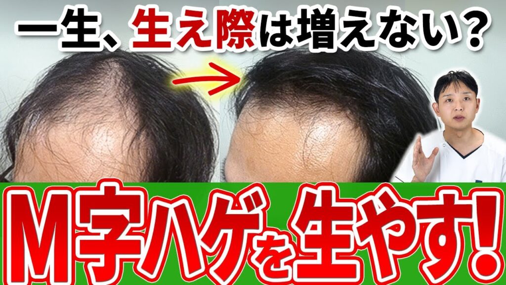 【M字ハゲ】生え際の薄毛を治す方法はある？3つの症例から効果的な増やし方を紹介します！
