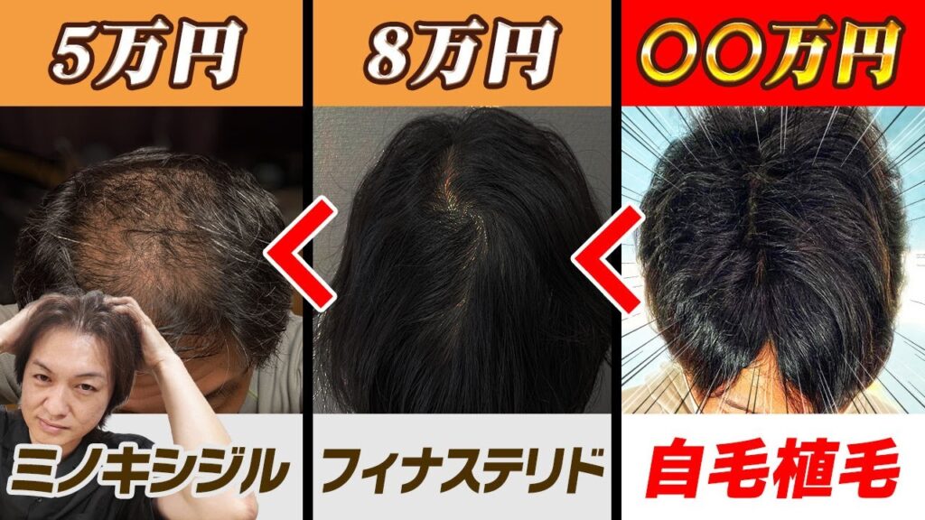 自毛植毛と薬の費用と効果はこれだけ違います。