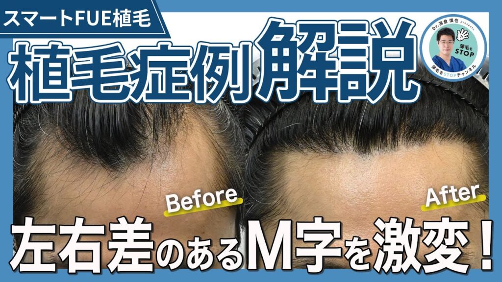 【植毛症例解説】左右差のあるM字を激変！