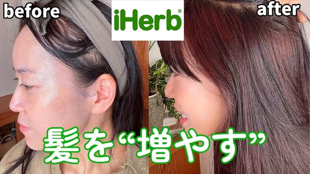 【iHerb】2ヵ月で髪が増えた!増毛、育毛に効くアイテム2選🌿