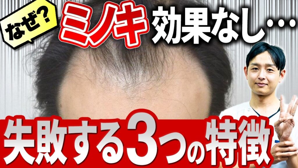 【発毛剤】ミノキシジルを使って生えない人に共通する3つの失敗ポイントを伝えます！