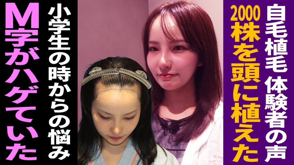 【自毛植毛 ヘアライン】女性インフルエンサーの悩み/髪の毛が無い/2000株の植毛