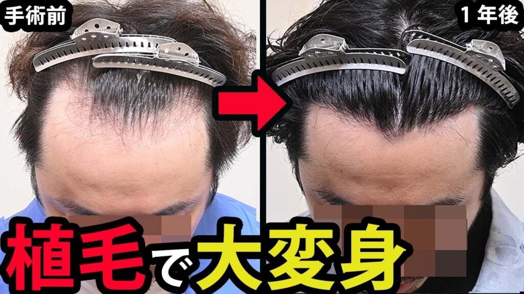 【高密度植毛】M字生え際が自毛植毛で激変。1500グラフトで薄毛改善