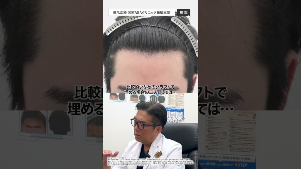 元々M字が広くておでこを出せない…20代男性の治療解説#自毛植毛