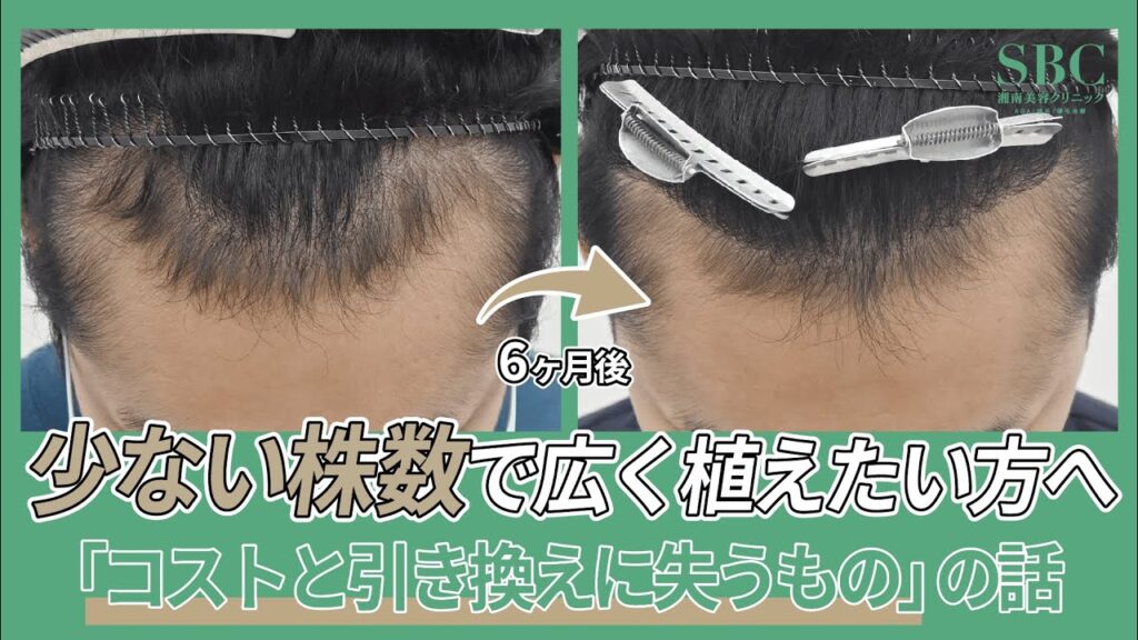 自毛植毛の費用を抑えるために「同じ株数で広範囲に植える」←これ当院ではやりません