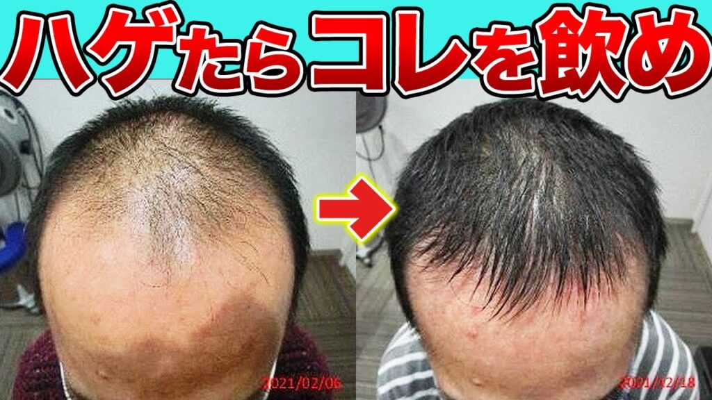 【発毛のプロが推奨】薄毛改善に効くおすすめサプリメントを7つ紹介