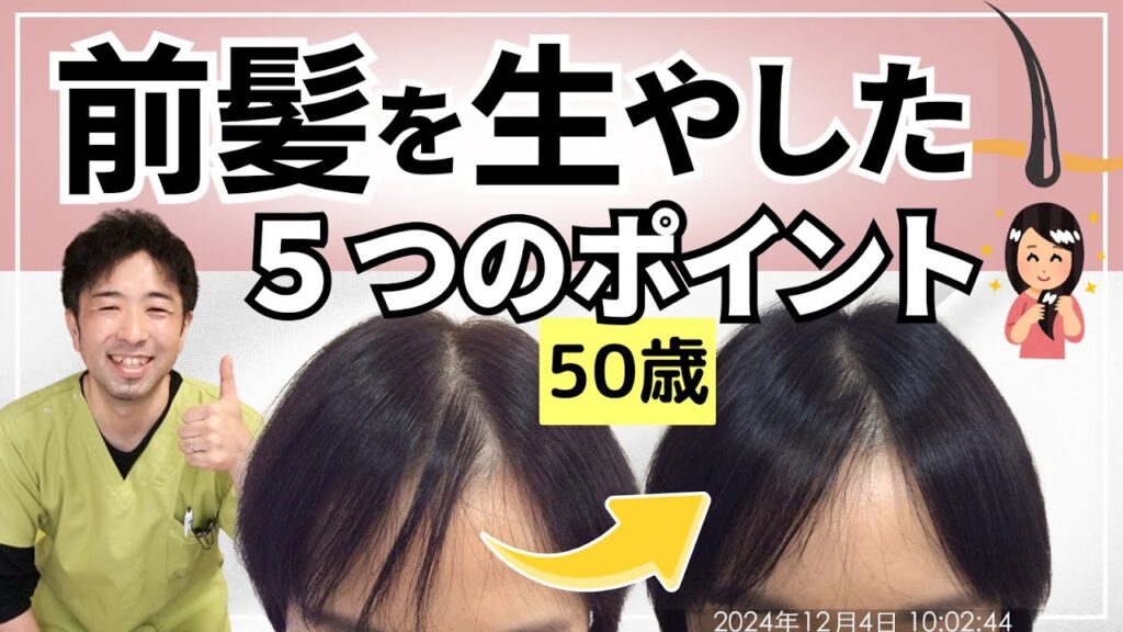 【50歳女性発毛症例】更年期×ホルモン療法による前髪薄毛を改善した5つのポイント