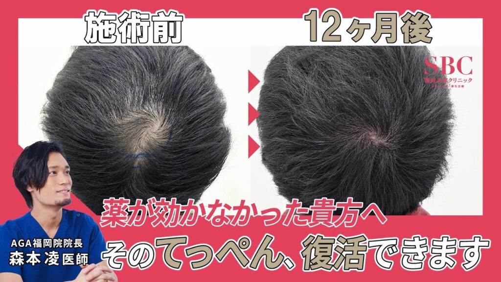 頭頂部の薄毛を改善したい…つむじはげを1年後に確実に生やす自毛植毛