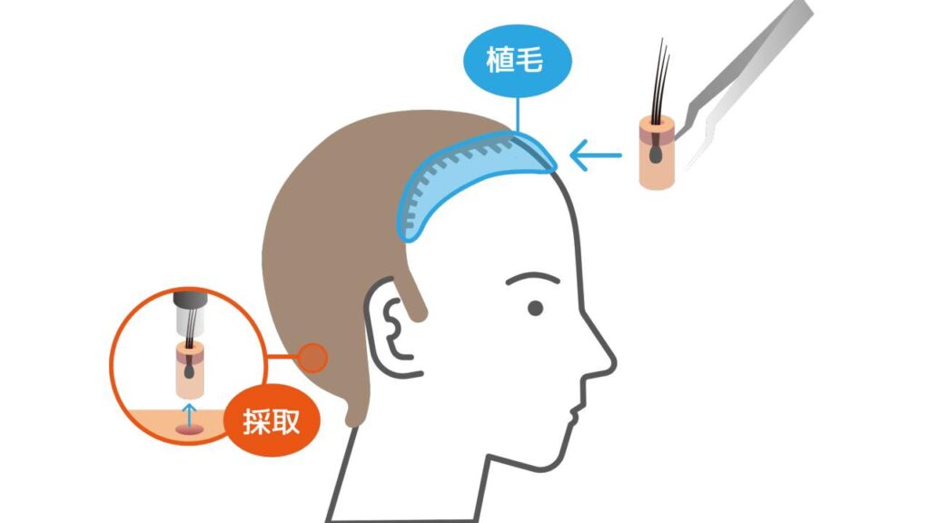 外科治療「自毛植毛」