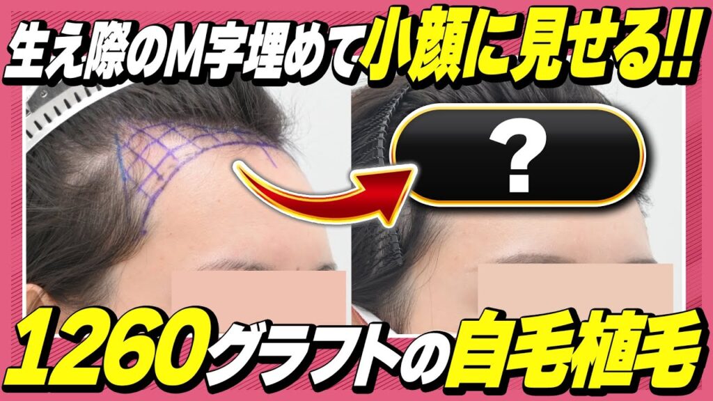 【自毛植毛】女性のM字をナチュラルに埋める！自然な生え際を作るデザインの秘訣を解説！