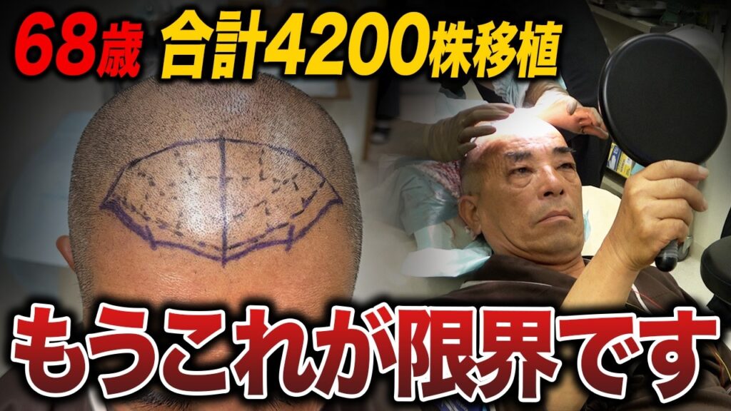 【68歳2回目の植毛】限界の密度で挑んだ結果…まさかの問題発生!?