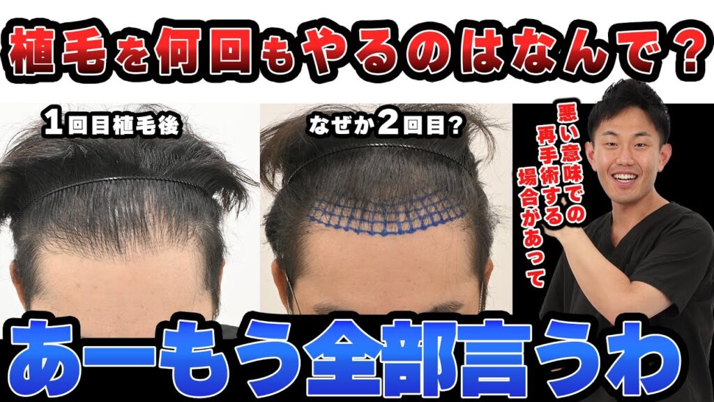【症例紹介】自毛植毛って何回もできる?2回以上する理由を解説!