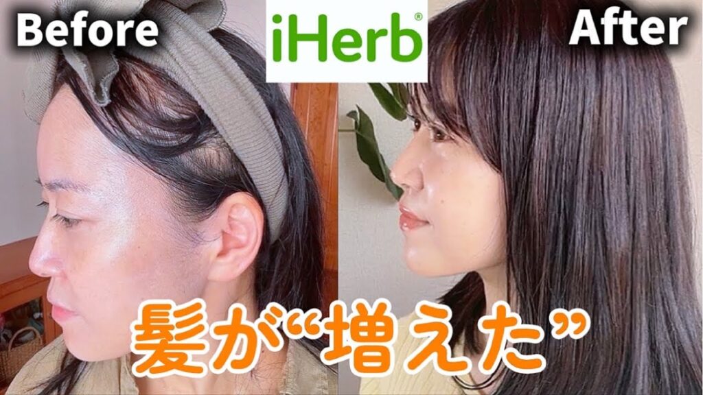 【iHerb】半年で髪が増えた!増毛、育毛アイテムの経過報告🌿