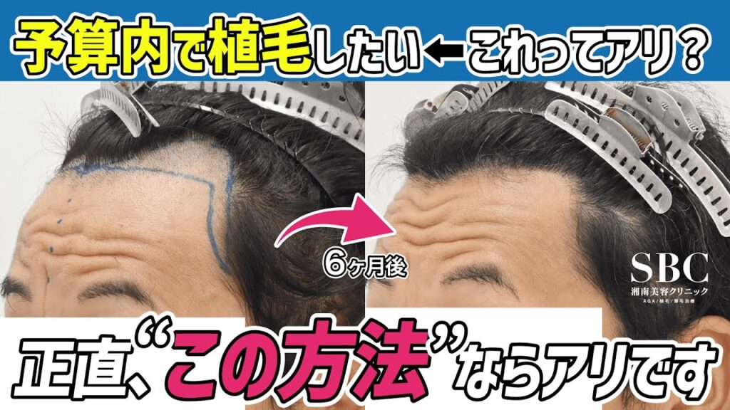 【ぶっちゃけ】自毛植毛の費用を予算内に抑える方法(限度はあります)
