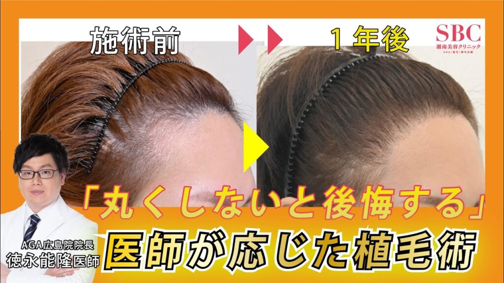 【自毛植毛】男性が『女性のようなまん丸ヘアライン』を強く希望!1年後のビフォーアフター