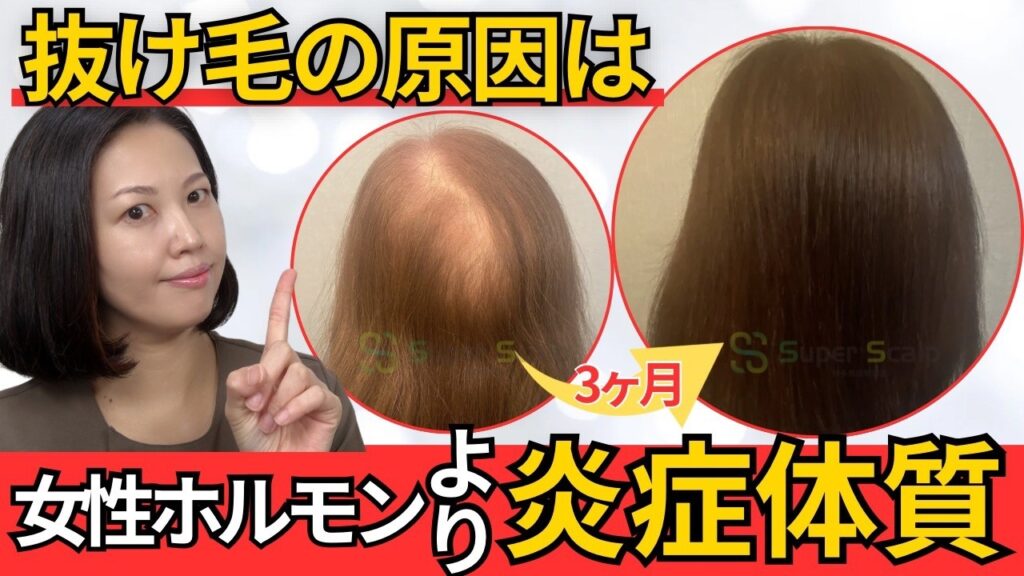 女性ホルモンだけじゃない!更年期の抜け毛を悪化させる「炎症体質」とは?