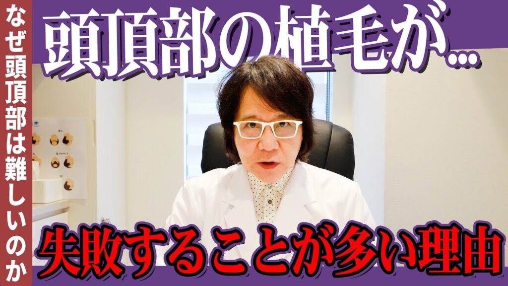 【自毛植毛】頭頂部への植毛が難しい理由を解説！！【植毛】【AGA治療】