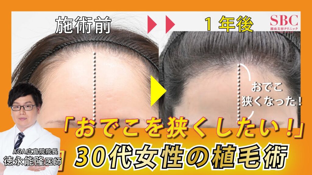 【女性の自毛植毛】おでこを狭くしすぎるとどうなる?徳永医師が示す「ギリギリ限界ライン」