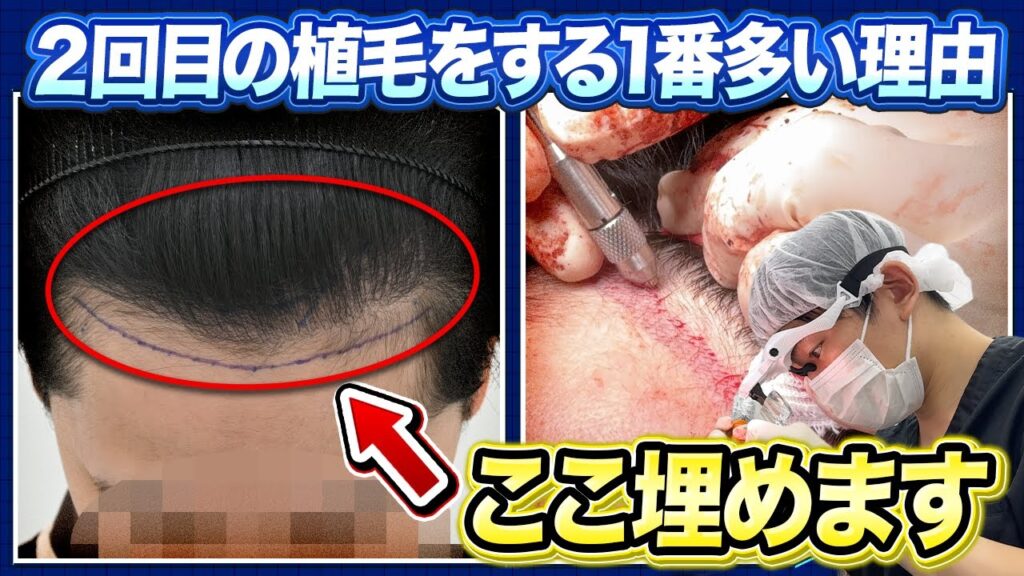 【密度アップ】2回目の植毛でここまで変わる。「不自然にならないデザイン」の極意を全て見せます
