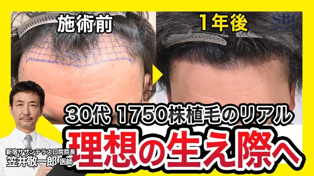 【自毛植毛】30代M字・生え際に1750株。AGA治療歴なしからの劇的変化を医師が解説