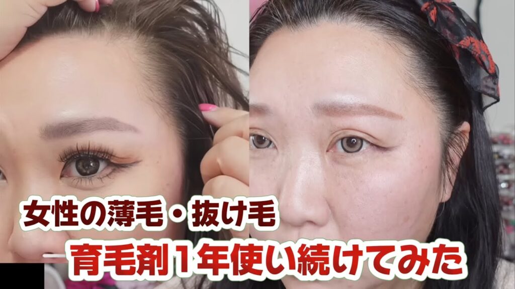 【女性の薄毛・抜け毛】育毛剤1年使い続けてみた結果・・・