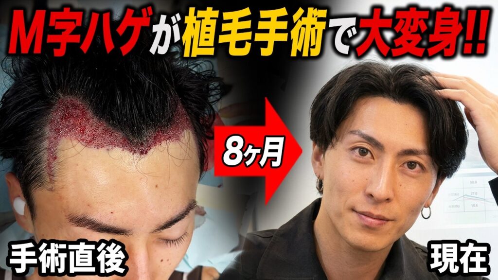 【植毛8ヶ月経過】 M字ハゲだった28歳がどんどん男前に変身!!