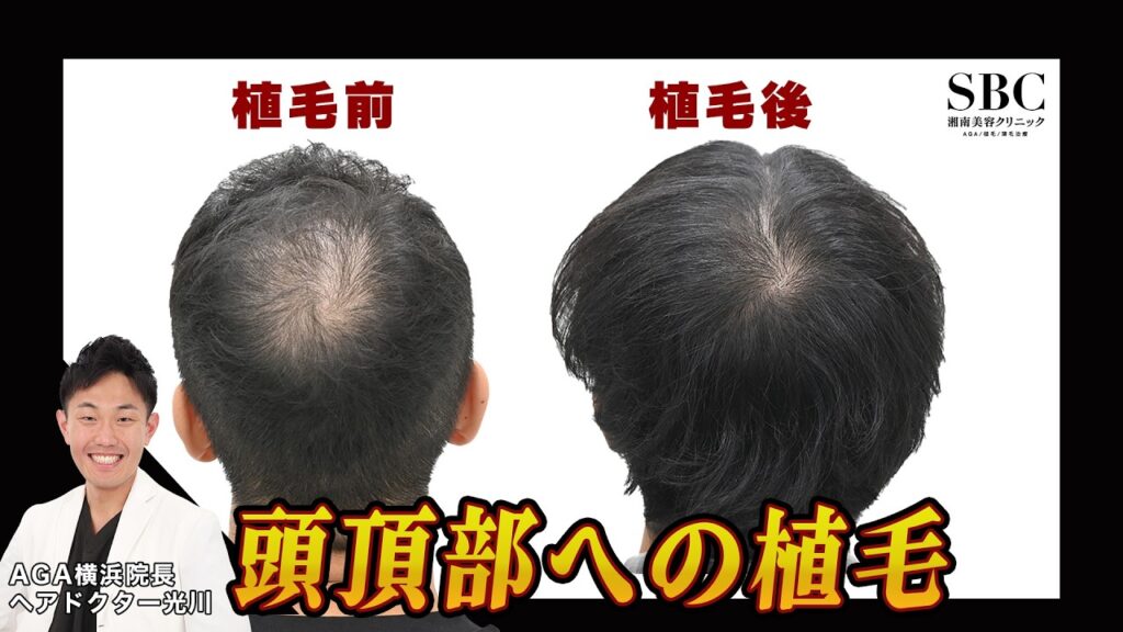 【AGA治療】頭頂部に自毛植毛をした男性の経過を解説！
