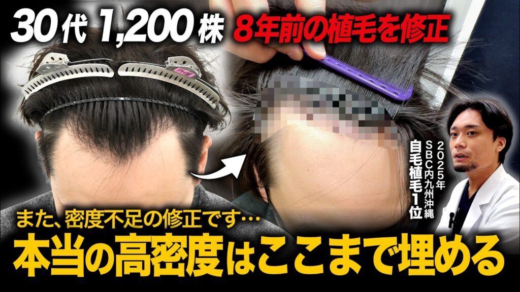 2回目の植毛…失敗とされやすい密度不足を高密度に修正|30代1200株の1年経過