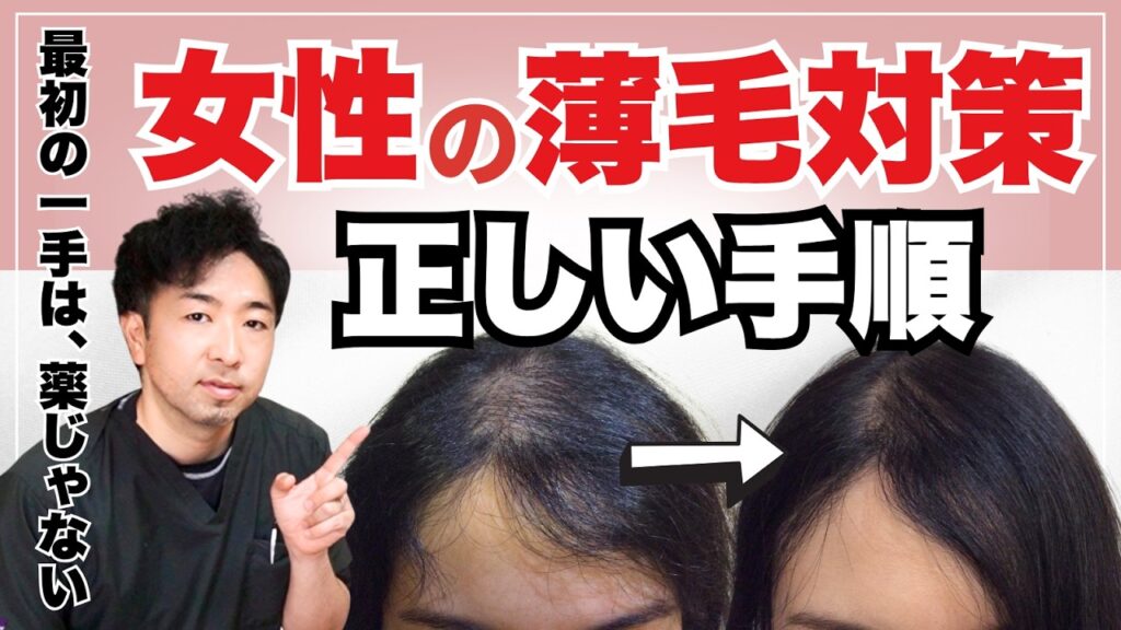 【保存版】女性の薄毛でミノキシジルの前にするべき3つの対策ロードマップ