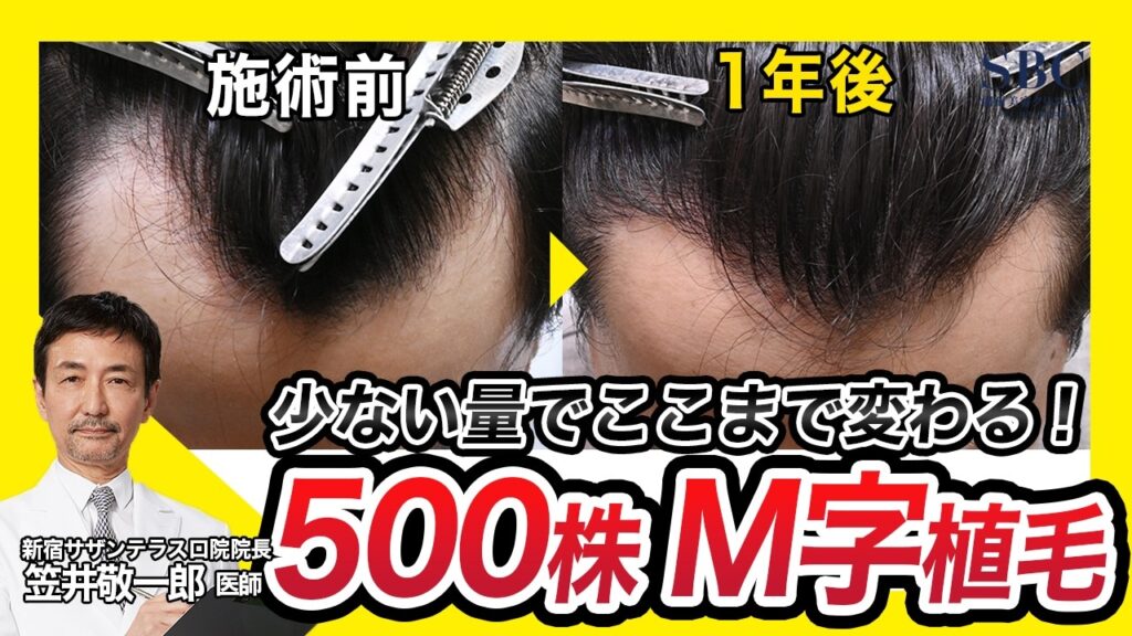 自毛植毛500株でM字を埋める!刈り上げないノンシェーブン植毛の1年後【湘南AGA】